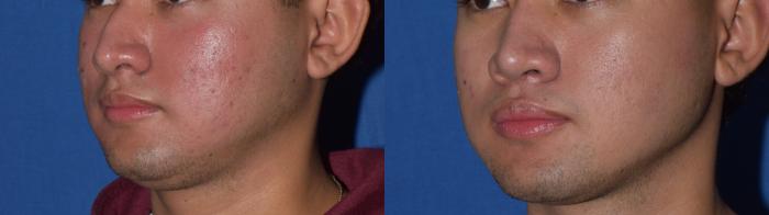 Before & After Rhinoplasty Case 10 Left Oblique View in South Miami, Florida