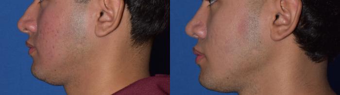 Before & After Rhinoplasty Case 10 Left Side View in South Miami, Florida