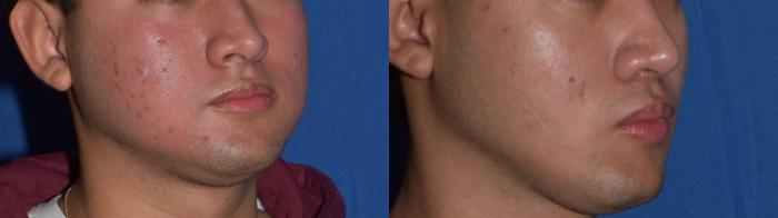 Before & After Rhinoplasty Case 10 Right Oblique View in South Miami, Florida