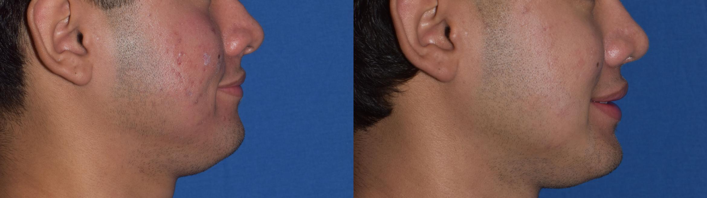 Before & After Rhinoplasty Case 10 Right Side Smiling View in South Miami, Florida