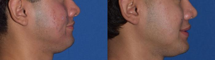 Before & After Rhinoplasty Case 10 Right Side Smiling View in South Miami, Florida