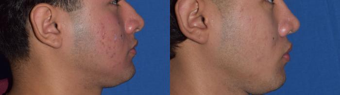 Before & After Rhinoplasty Case 10 Right Side View in South Miami, Florida