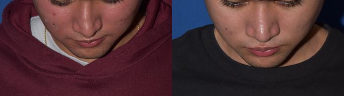 Before & After Rhinoplasty Case 10 Top View in South Miami, Florida