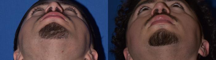 Before & After Rhinoplasty Case 11 Bottom View in South Miami, Florida