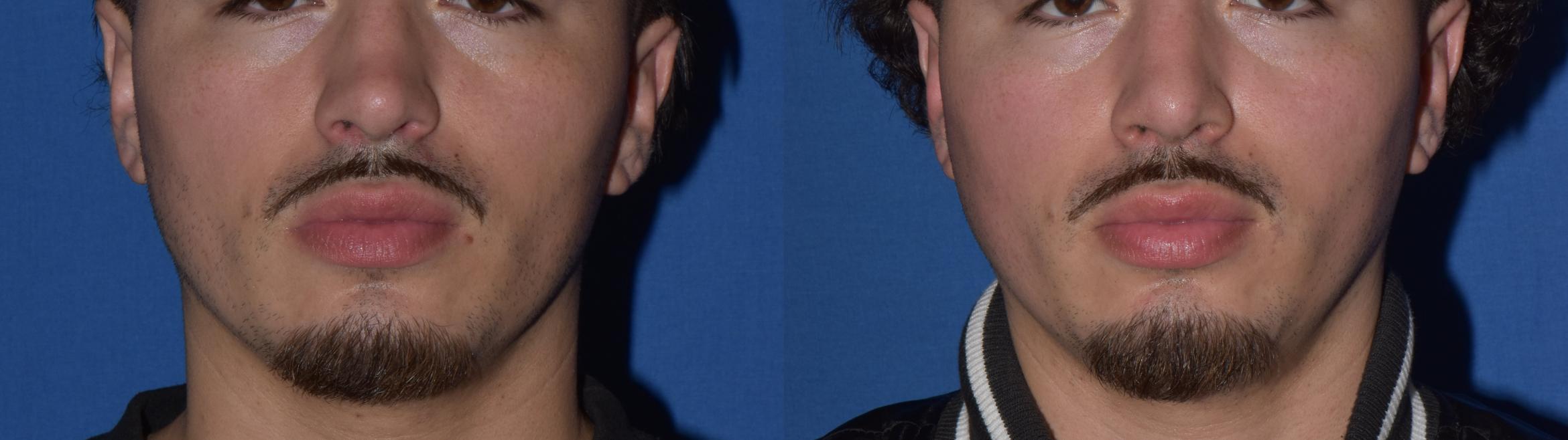 Before & After Rhinoplasty Case 11 Front View in South Miami, Florida