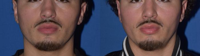 Before & After Rhinoplasty Case 11 Front View in South Miami, Florida