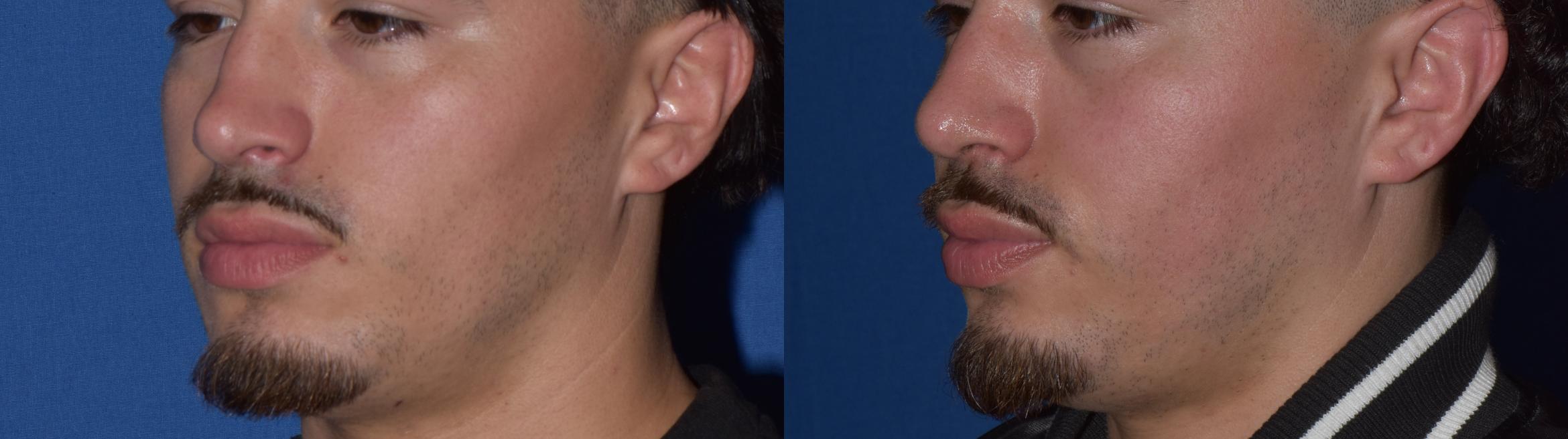Before & After Rhinoplasty Case 11 Left Oblique View in South Miami, Florida