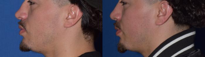 Before & After Rhinoplasty Case 11 Left Side View in South Miami, Florida