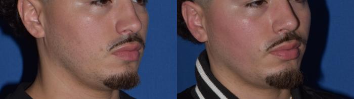 Before & After Rhinoplasty Case 11 Right Oblique View in South Miami, Florida
