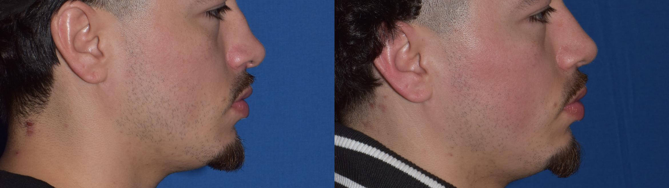 Before & After Rhinoplasty Case 11 Right Side View in South Miami, Florida