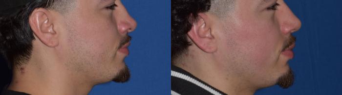Before & After Rhinoplasty Case 11 Right Side Smiling View in South Miami, Florida