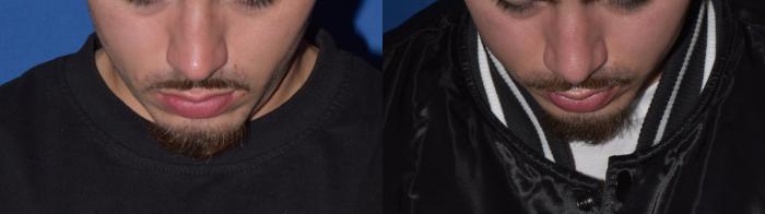 Before & After Rhinoplasty Case 11 Top View in South Miami, Florida