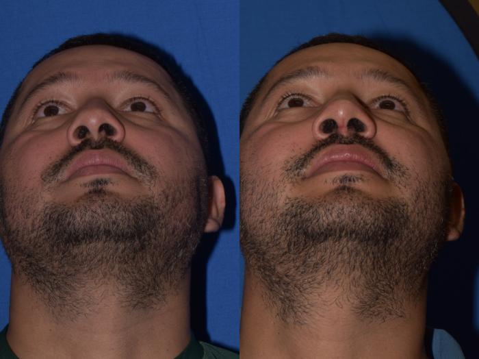 Before & After Rhinoplasty Case 12 Bottom View in South Miami, Florida