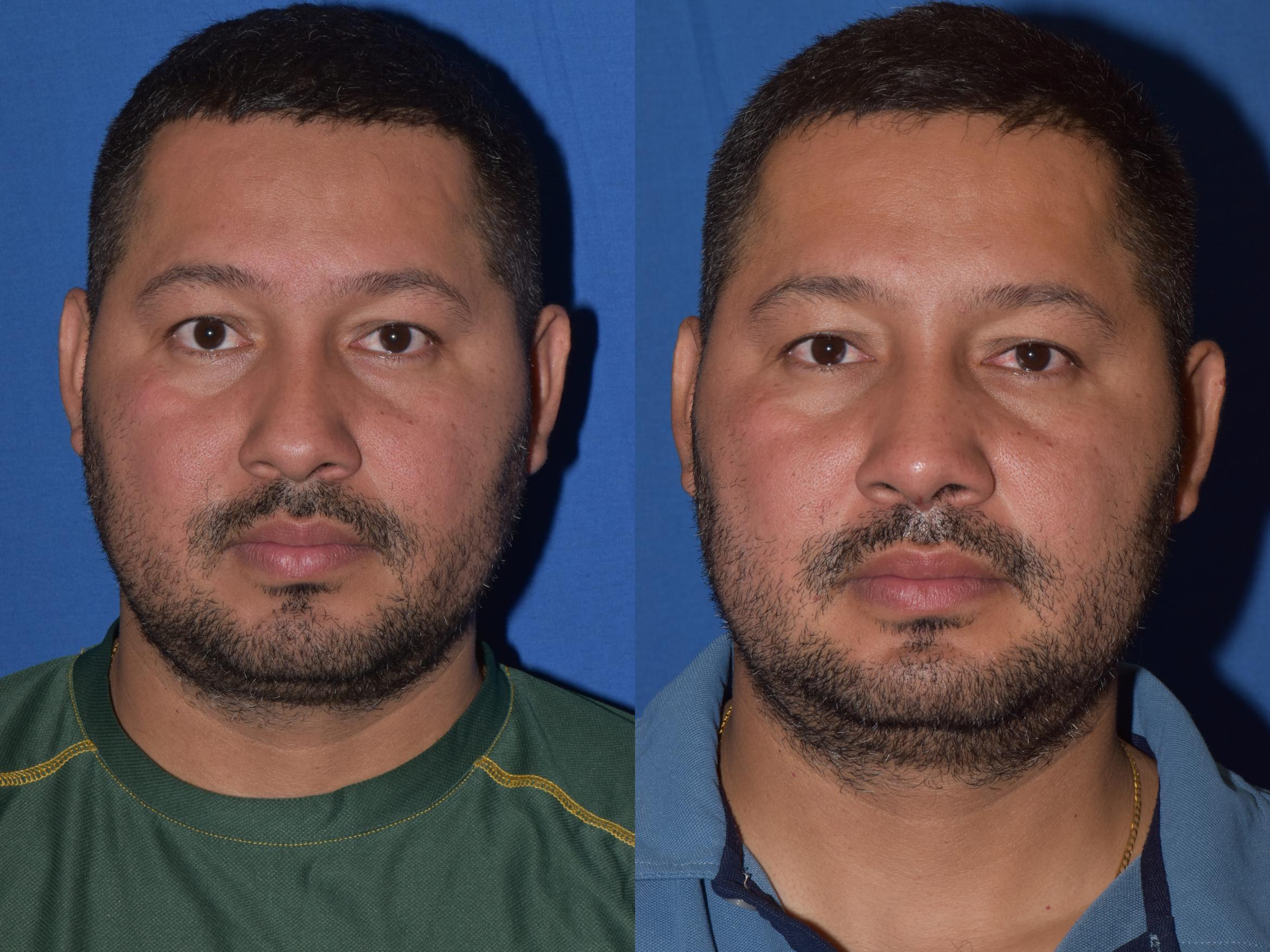 Before & After Rhinoplasty Case 12 Front View in South Miami, Florida