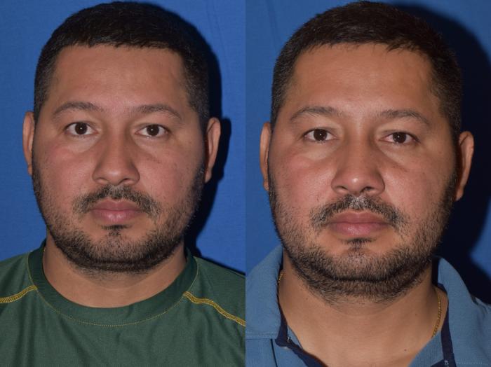 Before & After Rhinoplasty Case 12 Front View in South Miami, Florida