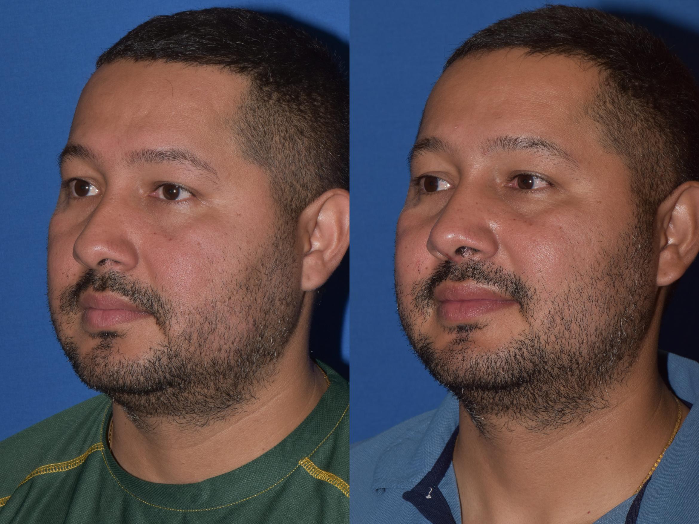 Before & After Rhinoplasty Case 12 Left Oblique View in South Miami, Florida