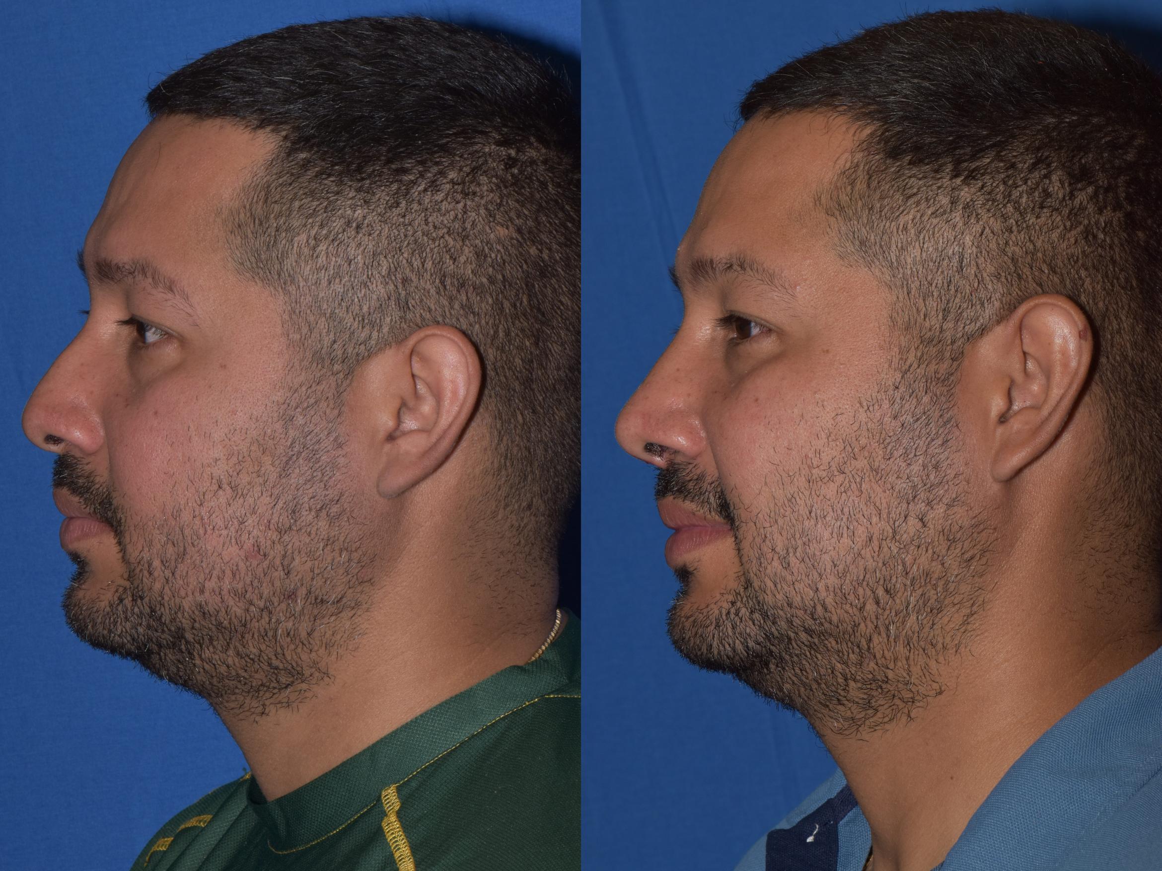 Before & After Rhinoplasty Case 12 Left Side View in South Miami, Florida