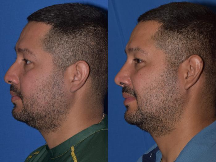 Before & After Rhinoplasty Case 12 Left Side View in South Miami, Florida