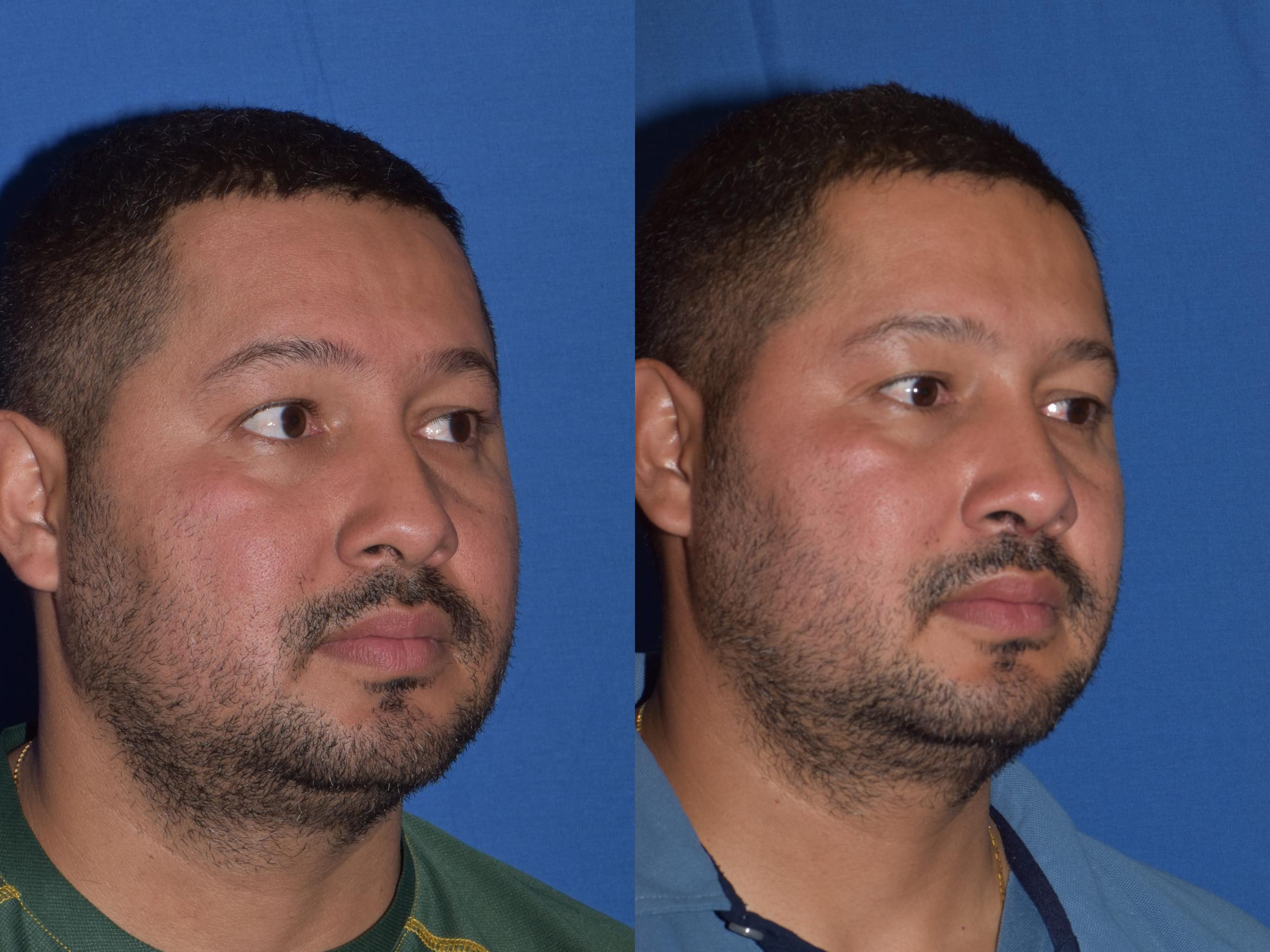 Before & After Rhinoplasty Case 12 Right Oblique View in South Miami, Florida