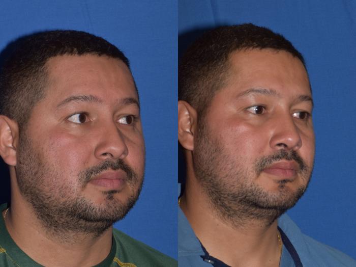 Before & After Rhinoplasty Case 12 Right Oblique View in South Miami, Florida