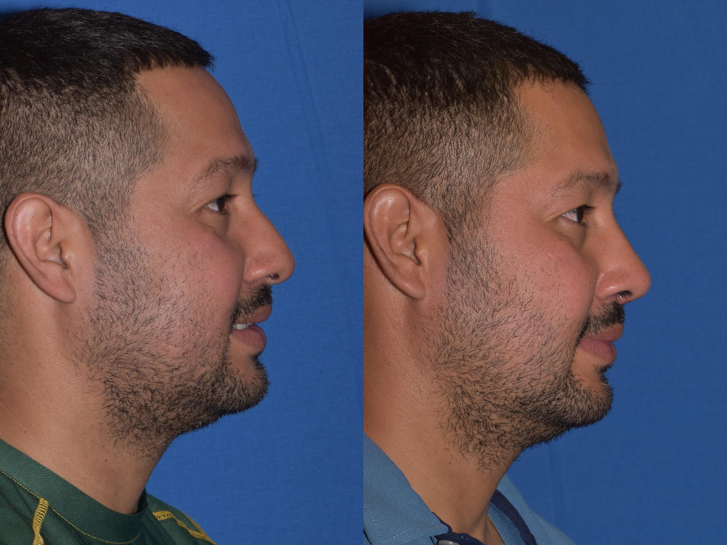 Before & After Rhinoplasty Case 12 Right Side Smiling View in South Miami, Florida
