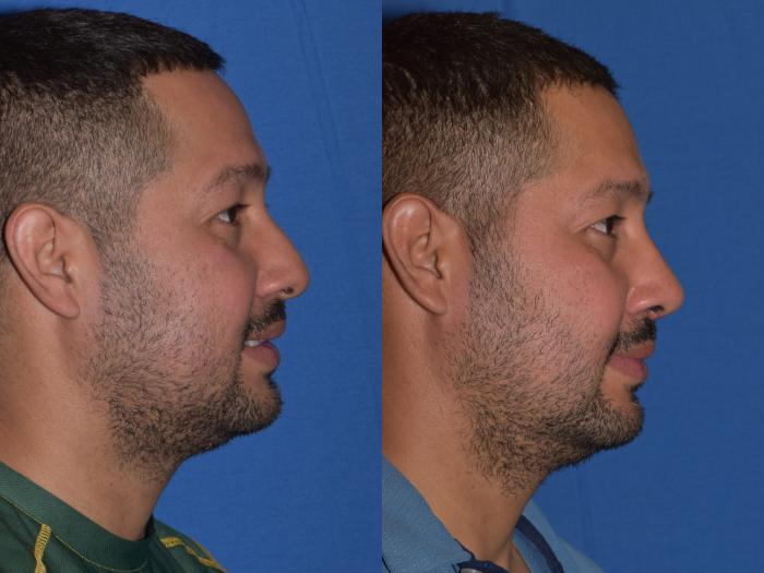 Before & After Rhinoplasty Case 12 Right Side Smiling View in South Miami, Florida