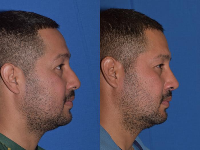 Before & After Rhinoplasty Case 12 Right Side View in South Miami, Florida
