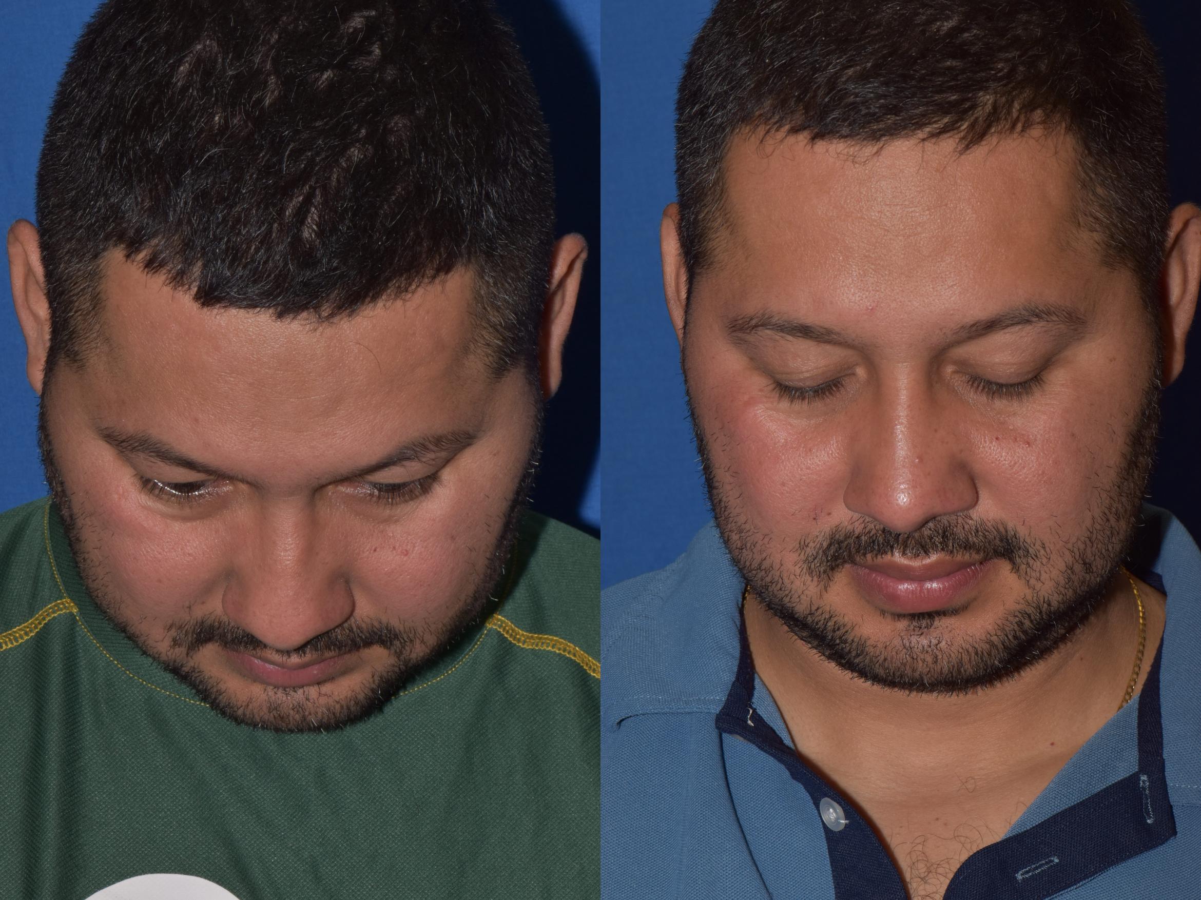 Before & After Rhinoplasty Case 12 Top View in South Miami, Florida