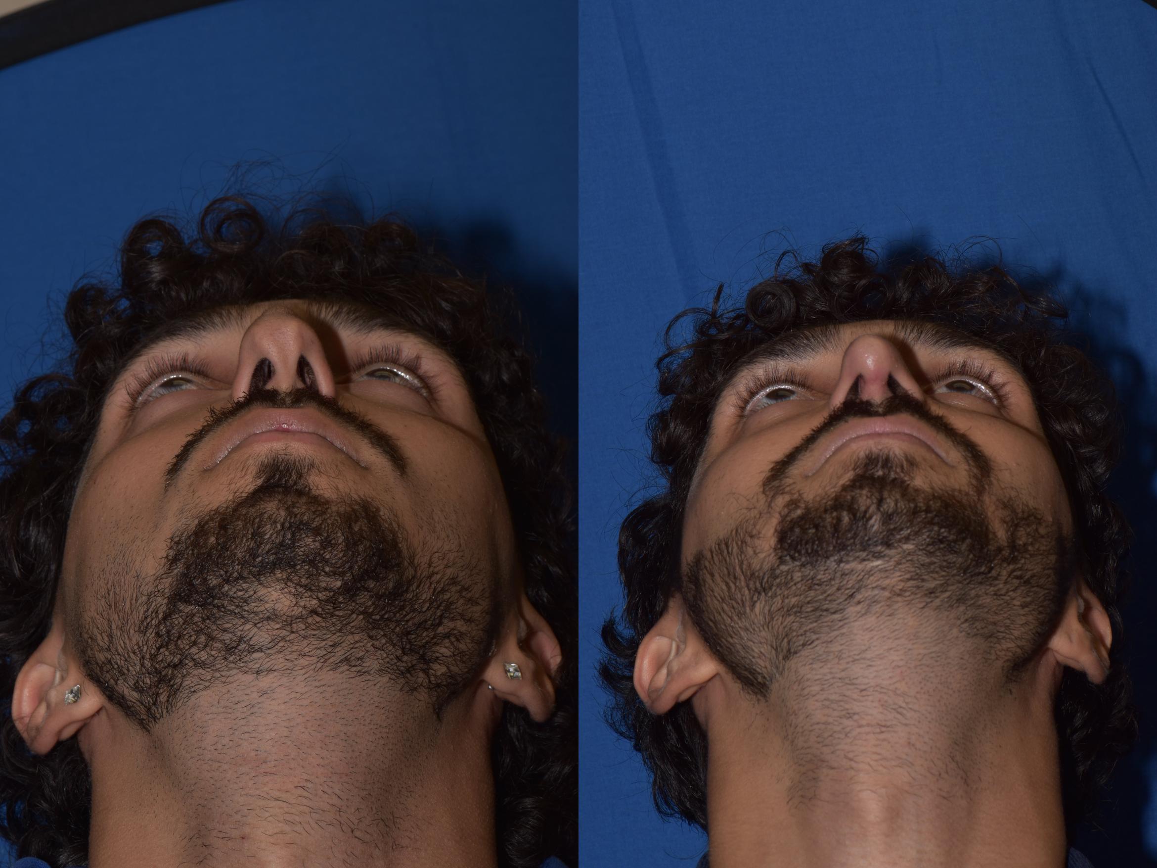 Before & After Rhinoplasty Case 13 Bottom View in South Miami, Florida