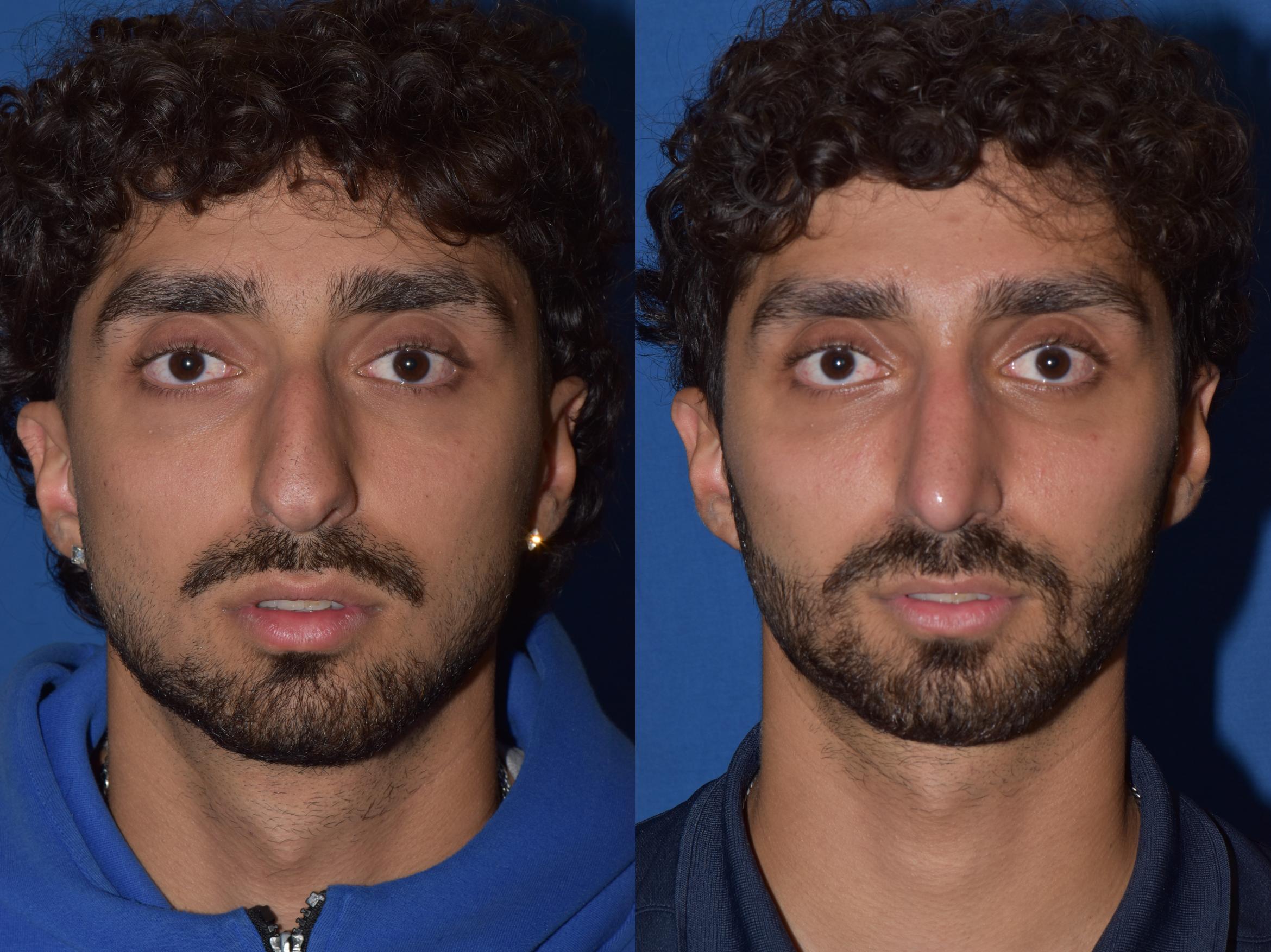 Before & After Rhinoplasty Case 13 Front View in South Miami, Florida