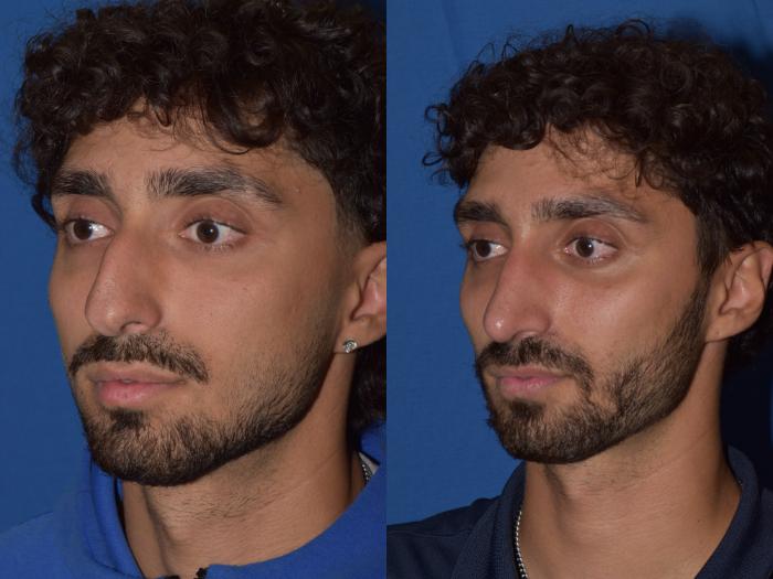 Before & After Rhinoplasty Case 13 Left Oblique View in South Miami, Florida