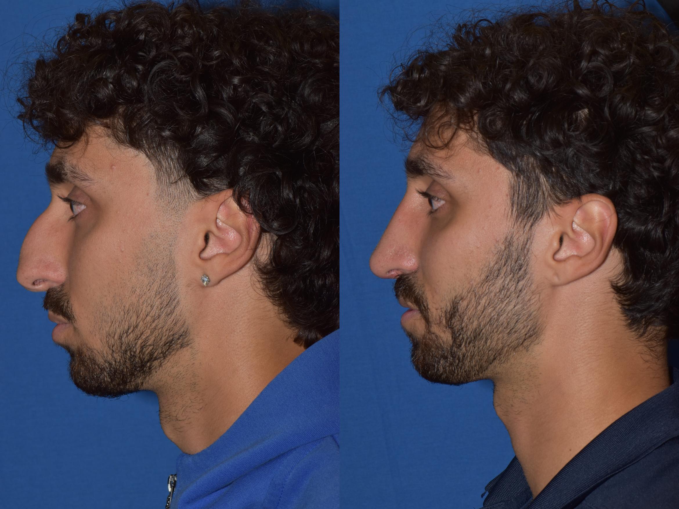 Before & After Rhinoplasty Case 13 Left Side View in South Miami, Florida