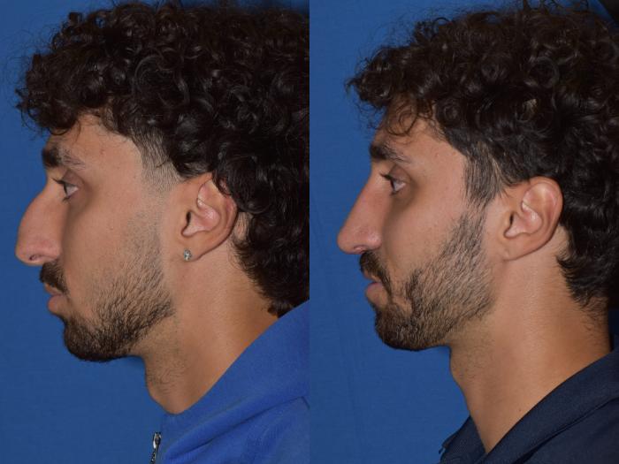 Before & After Rhinoplasty Case 13 Left Side View in South Miami, Florida