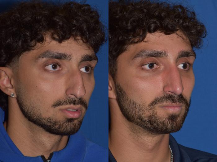 Before & After Rhinoplasty Case 13 Right Oblique View in South Miami, Florida