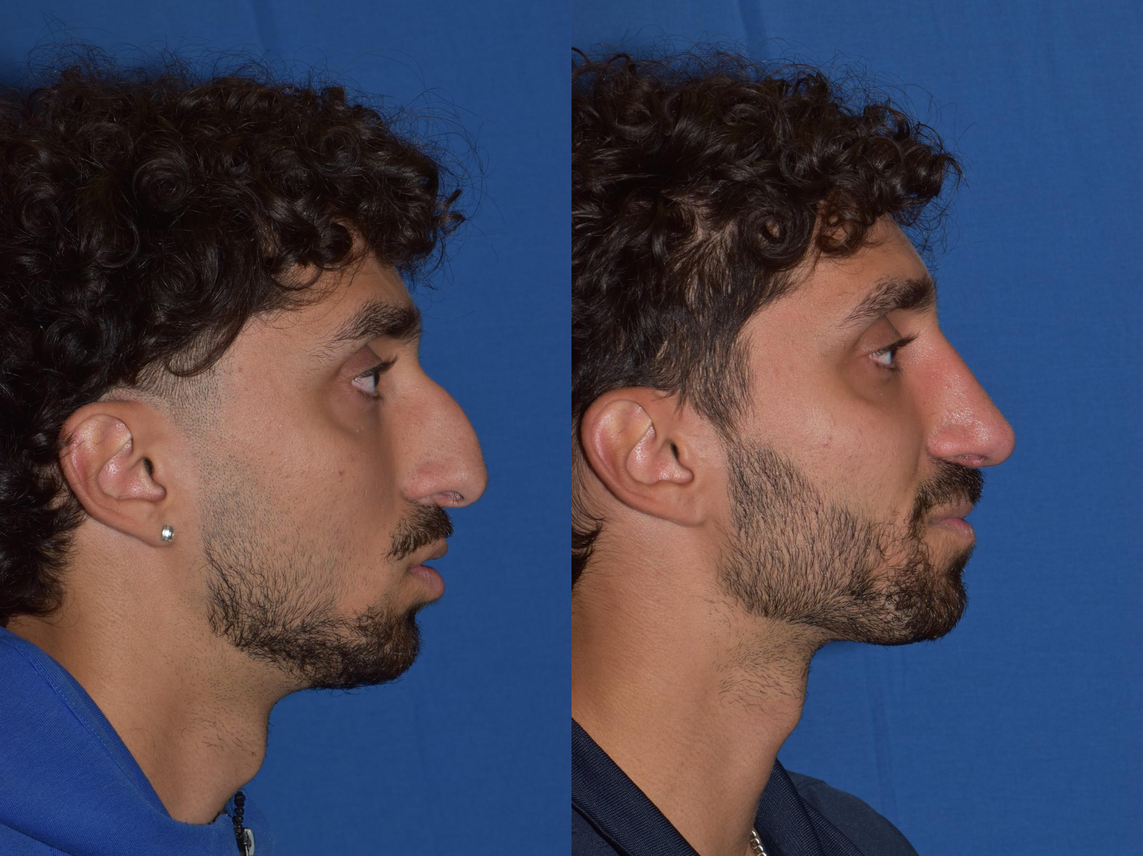 Before & After Rhinoplasty Case 13 Right Side View in South Miami, Florida