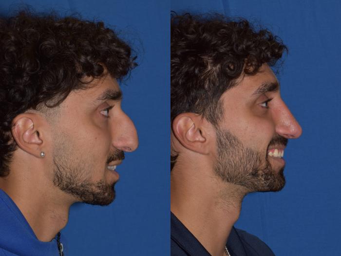 Before & After Rhinoplasty Case 13 Right Side Smiling View in South Miami, Florida