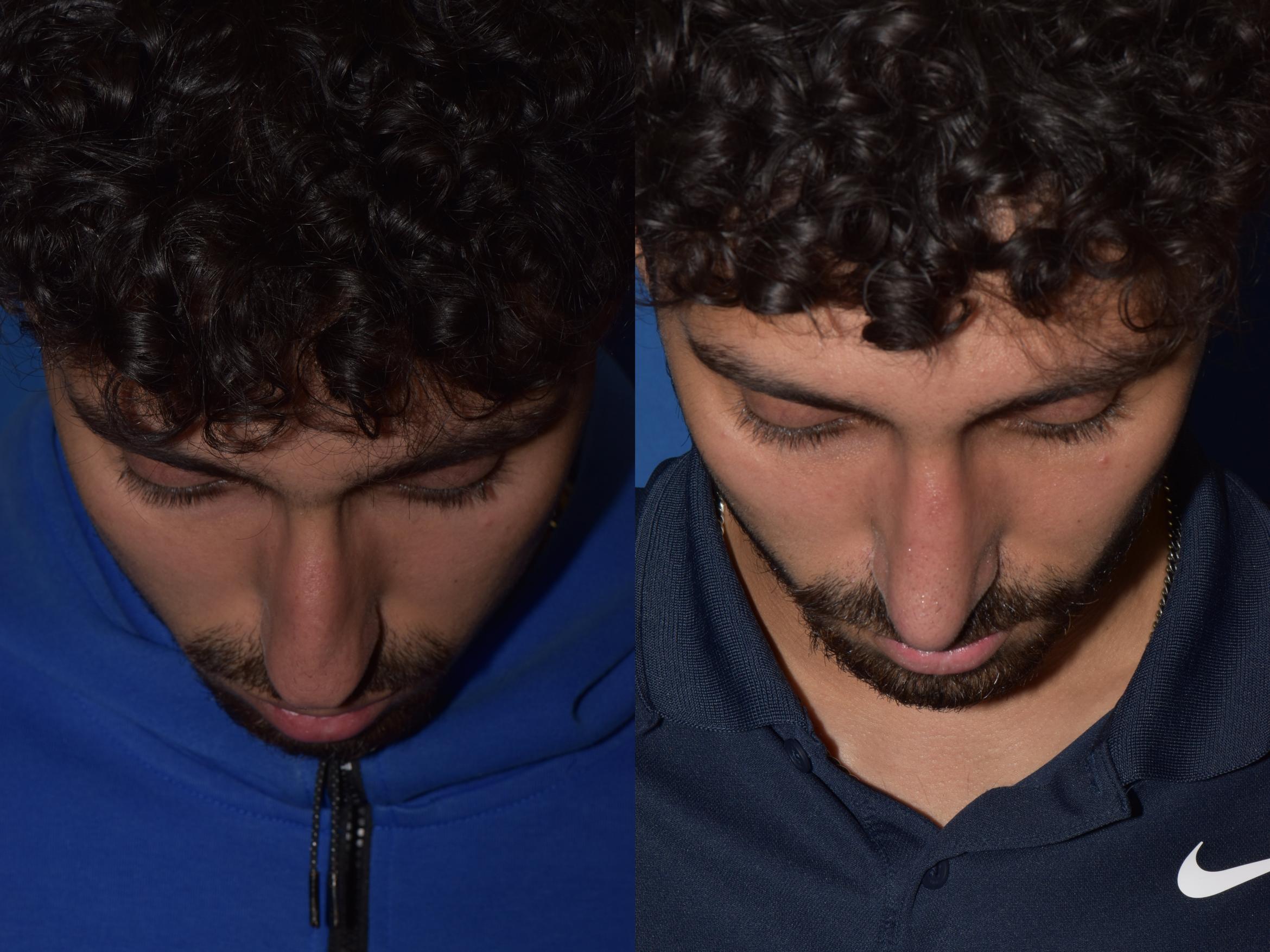 Before & After Rhinoplasty Case 13 Top View in South Miami, Florida