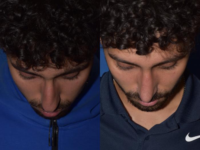 Before & After Rhinoplasty Case 13 Top View in South Miami, Florida