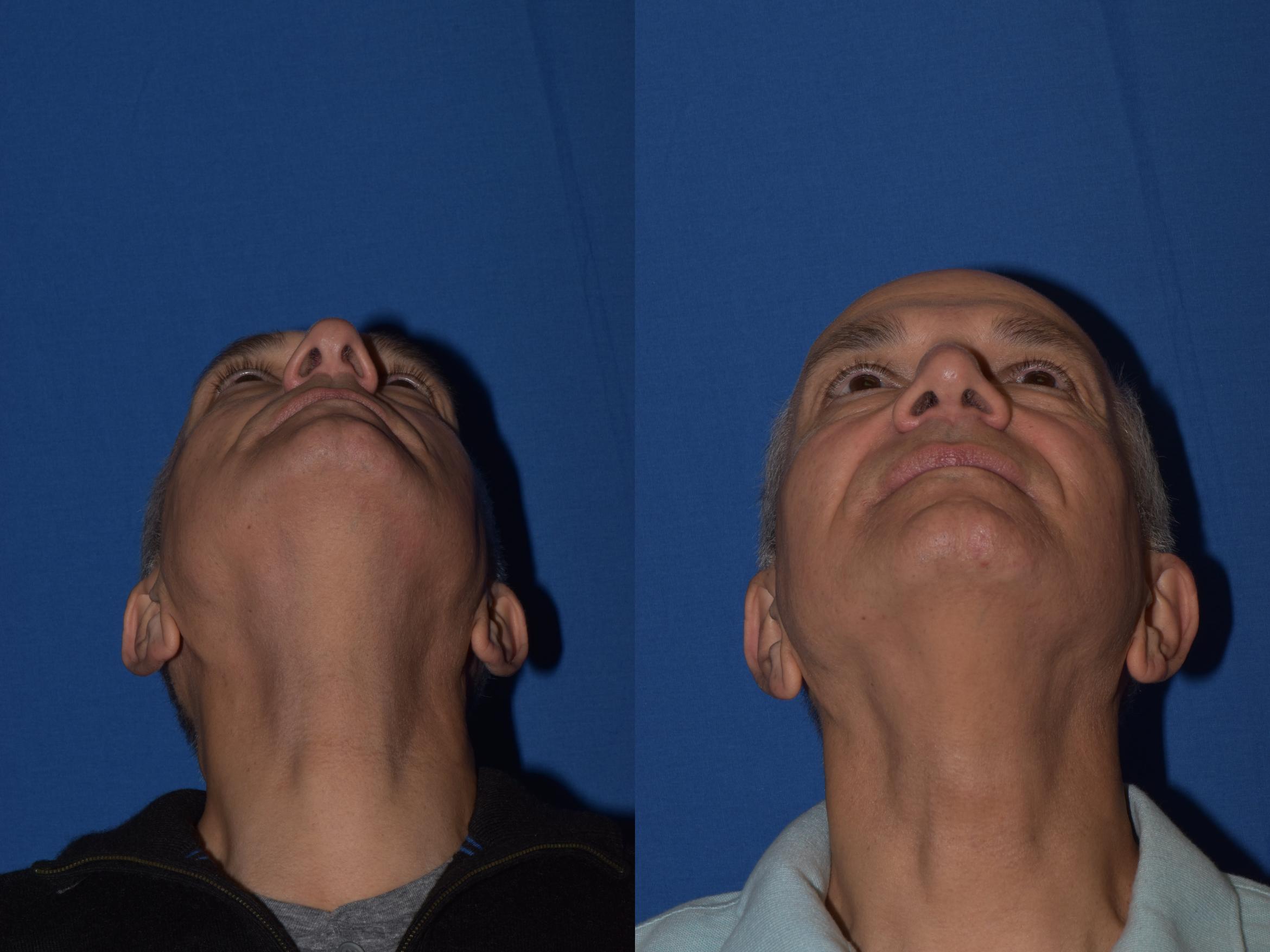 Before & After Rhinoplasty Case 14 Bottom View in South Miami, Florida
