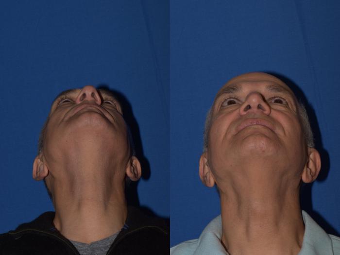 Before & After Rhinoplasty Case 14 Bottom View in South Miami, Florida
