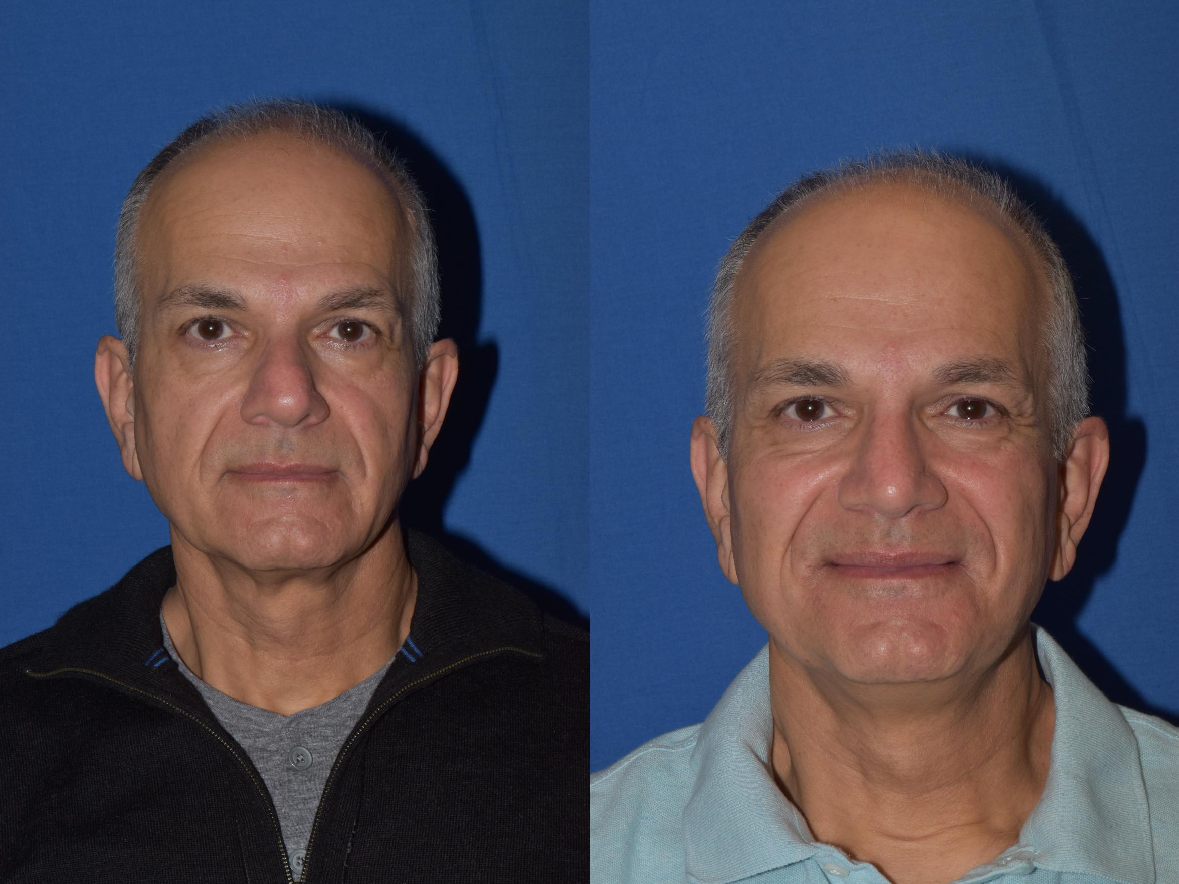 Before & After Rhinoplasty Case 14 Front View in South Miami, Florida