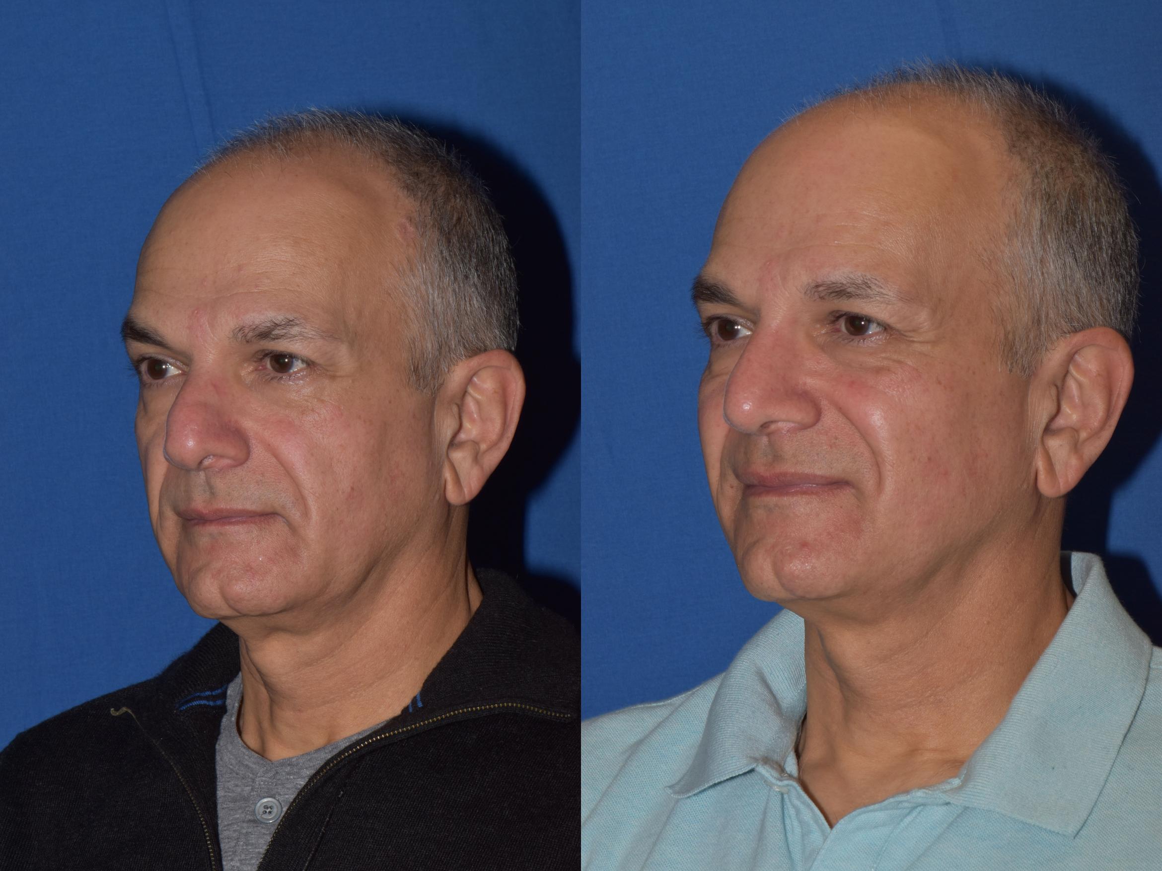 Before & After Rhinoplasty Case 14 Left Oblique View in South Miami, Florida