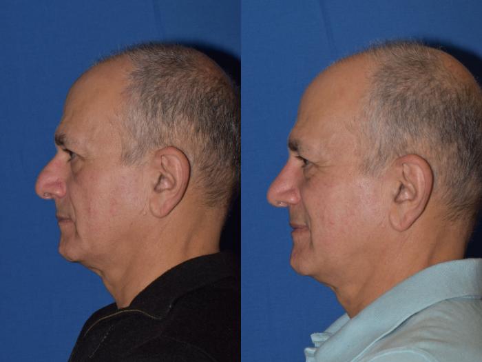Before & After Rhinoplasty Case 14 Left Side View in South Miami, Florida
