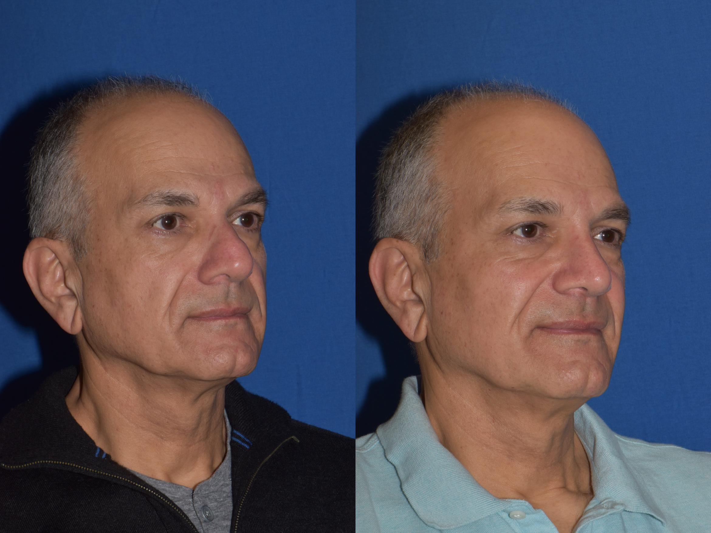 Before & After Rhinoplasty Case 14 Right Oblique View in South Miami, Florida