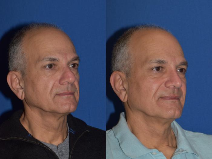 Before & After Rhinoplasty Case 14 Right Oblique View in South Miami, Florida