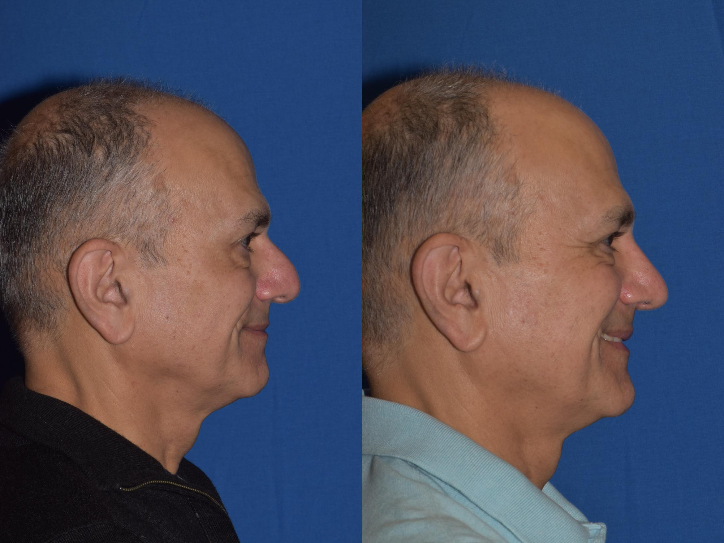 Before & After Rhinoplasty Case 14 Right Side Smiling View in South Miami, Florida