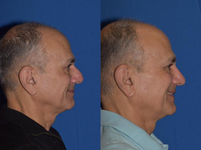 Before & After Rhinoplasty Case 14 Right Side Smiling View in South Miami, Florida
