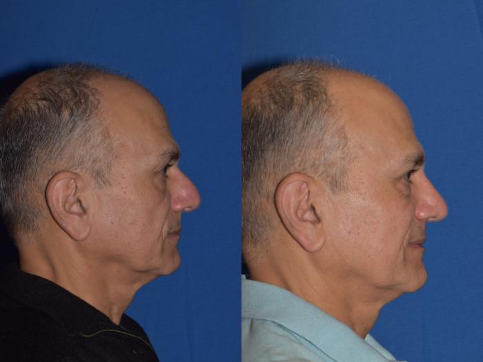 Before & After Rhinoplasty Case 14 Right Side View in South Miami, Florida