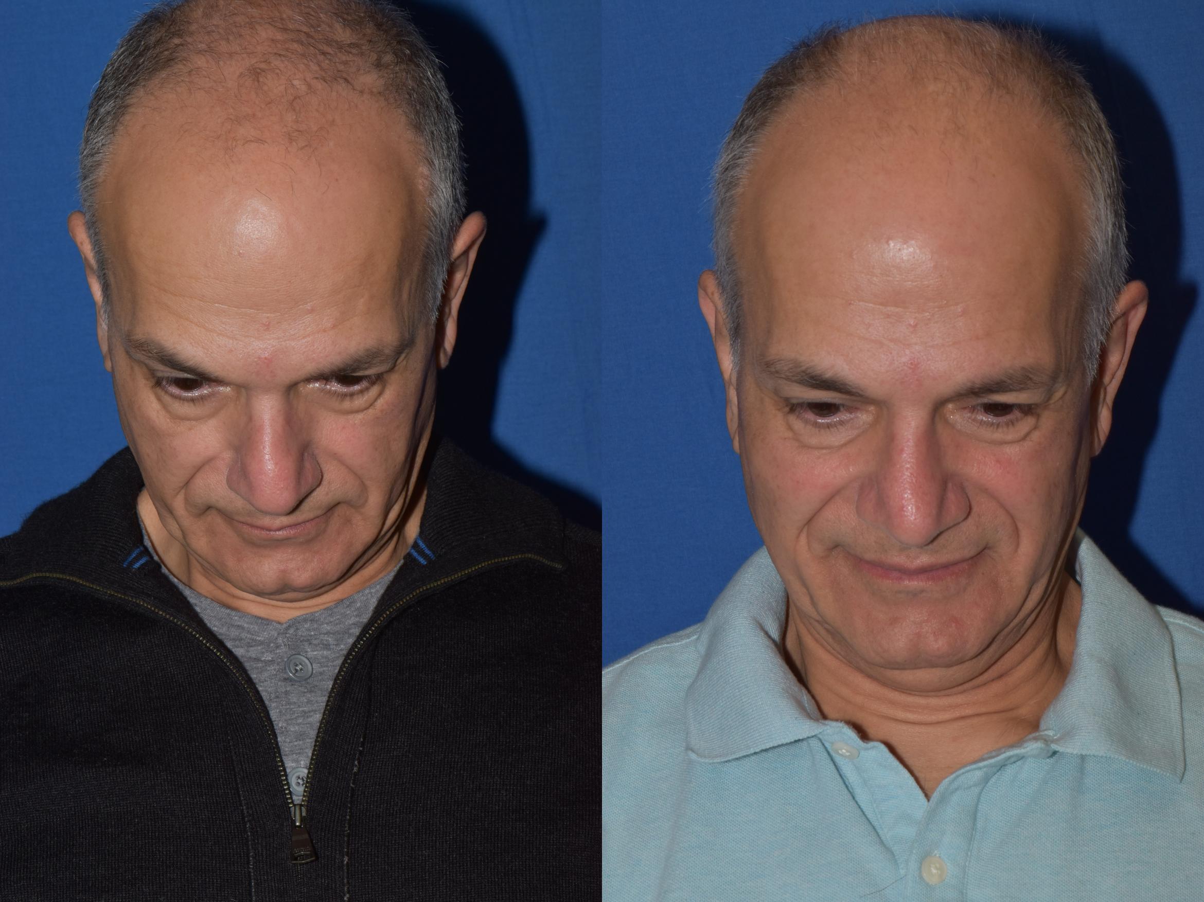 Before & After Rhinoplasty Case 14 Top View in South Miami, Florida