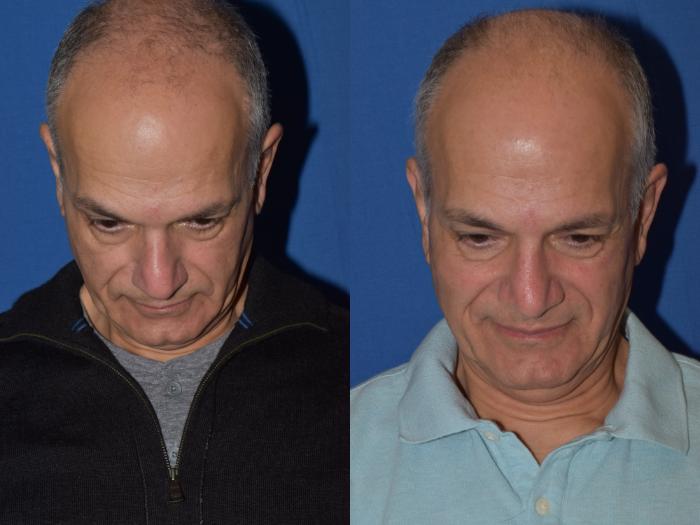 Before & After Rhinoplasty Case 14 Top View in South Miami, Florida